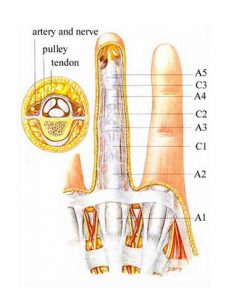 Trigger Finger Node Trigger Finger - Connecticut Orthopaedics