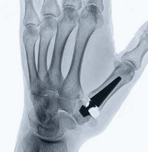 thumb prothesis